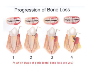 Bone-Loss1
