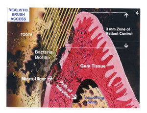 You can see in this picture your toothbrush can reach shallow gum infections  but not periodontal infections in the supporting bone.