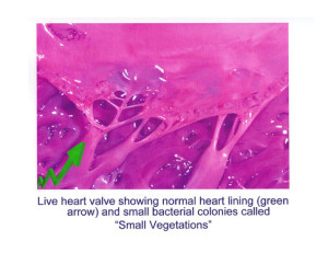 Note how disseminating oral infections can erode a patients heart valves.